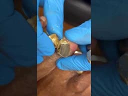 Ram’s Horn Toenail