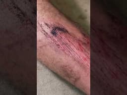 An E-Bike Burned the Skin Off My Shin 😵‍🔥🩸#shorts #funny #comedy