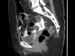 Intraperitoneal bladder rupture