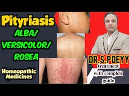 Pityriasis | शिउली या लिवर स्पोट | Homeopathic Medicines to control it