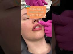 Creating a Perfect Pout with Filler