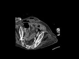 Complicated cholecystitis