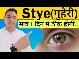 आँख की गुहेरी (बिलनी) से हमेशा के लिए छुटकारा || How to get rid of Stye.