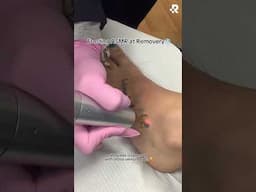 ASMR: Tattoo removal ❄️ #removery #tattooremoval