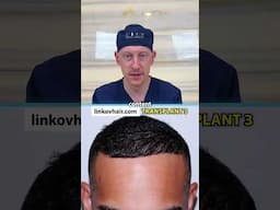 Is One Hair Transplant Enough?