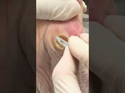 Years of Foot Pain Ends in Minutes! Deep Corn Extraction #satisfyingshorts  #satisfying #cornremoval