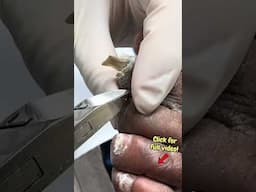 CUTTING 4 YEARS of Toenail Growth—You Have to See This! 😳 #satisfying #nailcutting