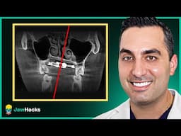 How to Avoid MARPE Asymmetry Complications