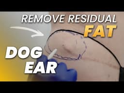 Tummy Tuck Left a Bulge? Let’s Talk Dog Ears and Residual Fat