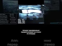 #узи #стеноз