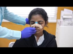 Bulky to Beautiful Rhinoplasty Results