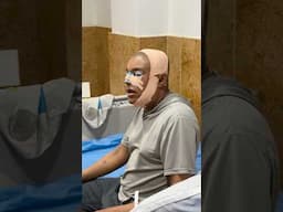 Major Face Surgery - Day 2