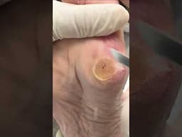 Insane Foot Care! Watch This Deep Corn Disappear 😳 #satisfyingshorts  #satisfying #cornremoval