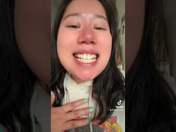 #adultbraces journey 🦷 #invisalign