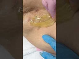 SUGARING | SUGAR WAX #waxing #sugarwaxing #sugaring #hairremoval