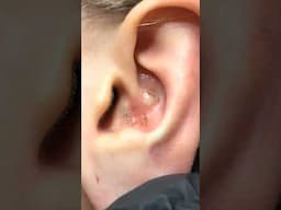 1 Minute Of Top ASMR Pimple Popping Video №111