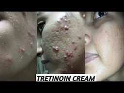 Tretinoin cream For Acne Scars || ट्रेटीनोईन क्रीम चेहरे के गढ्ढों के लिए Day 3/30 #acnescars