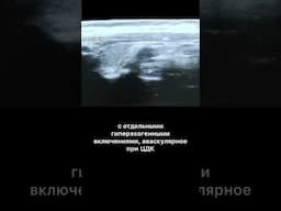 #гиперплазияпаращитовидной #узи