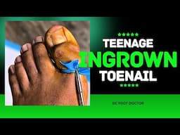 Teenage Ingrown Toenail