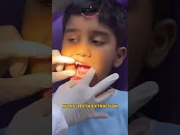 milky teeth extraction #dentalclinic  #teethcleaning  #teethextraction