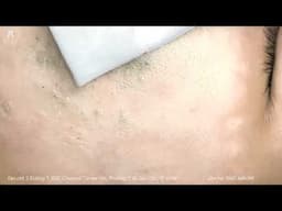 Big Cystic Acne Blackheads Extraction Blackheads & Milia, Whiteheads Removal Pimple Popping