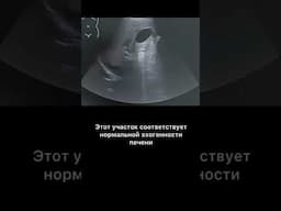 #узи #жировая инфильтрация
