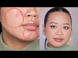 How to cover cystic acne ALL DAY with makeup (no filter)