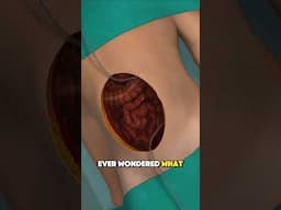 HIPEC (Hyperthermic intraperitoneal chemotherapy) 3d animation #medicalprocedure