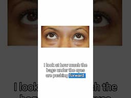 3 Determining Factors of Eye Bags Treatment #eyebags
