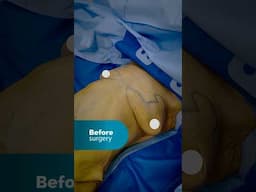 Live from Operating Room: 360 tummy tuck and breast reduction