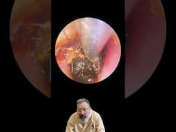 Super Compacted Ear Wax Plug Fights Back! Watch This Peel 👂🔥
