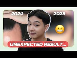 1 YEAR on HAIR LOSS MEDICATIONS: Worth it ba ang MINOXIDIL and FINASTERIDE? (My Personal Journey)