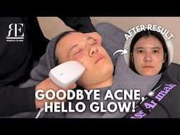 Acne & Scar Removal in Korea? I Tried Acne & Scar Treatment | Real Before & After Results