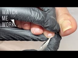 Pedicuring curved (involuted) toenails.