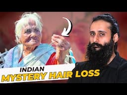 A Mysterious Hair Loss Case Of India | Bearded Chokra