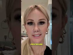 8 Days After My Upper Lip Lift
