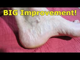 Veins in Your Feet Bulging, Popping Out on Inside.  Varicose Veins.  Poor Circulation Massage.