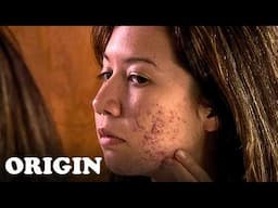 Living With SEVERE Acne | Remedy Me