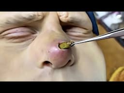 he said something was in his nose then..