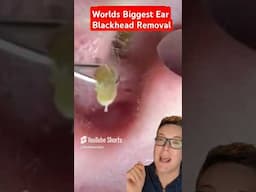 Worlds Biggest EAR BLACKHEAD REMOVAL #shorts