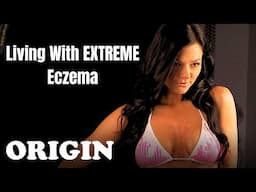 Learning To Live With My EXTREME Eczema | Remedy Me