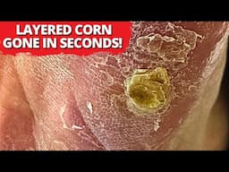 Deep, Flaky Foot Corn Extraction – Oddly Satisfying!