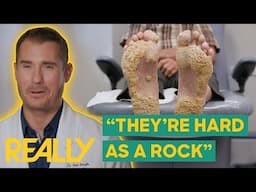 Dr. Brad Removes Barnacle-Like Growths From Patient's Feet l My Feet Are Killing Me