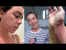 My TSW recovery | Trip to La Roche Posay Hydrotherapy Centre | LED infra red treatment