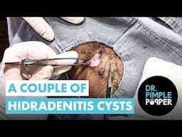 A Couple of Hidradenitis Cysts