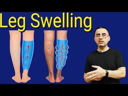Leg Swelling: Harmless Sign or Hidden Danger? Top Causes, Secret Triggers, and Fast Relief