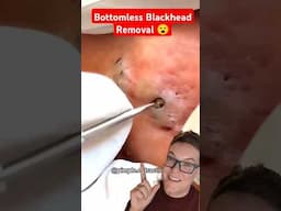 Bottomless BLACKHEAD REMOVAL - It Didnt Stop #shorts