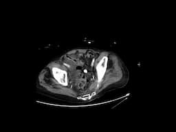 Retroperitoneal hematoma with active extravasation