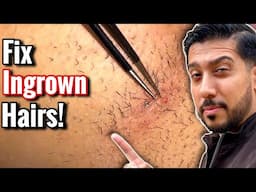 How to Stop Ingrown Hairs EASILY | Ingrown Hair Removal - 5 STEPS