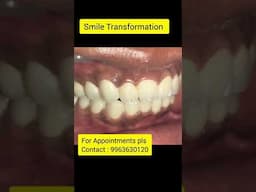 Smile Transformation